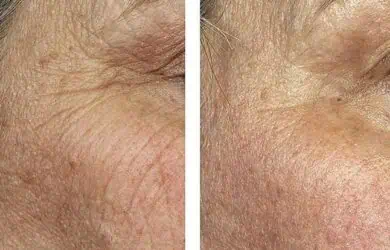 Новости – Docteur Bernard Hayot Как избавиться от морщин с помощью лазера и без операции?