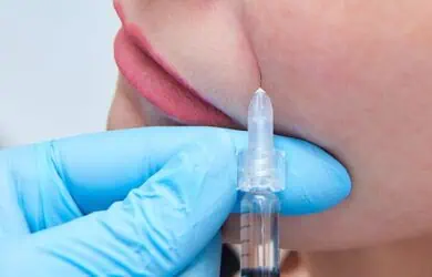 Новости – Docteur Bernard Hayot Микролипофилинг носогубных складок