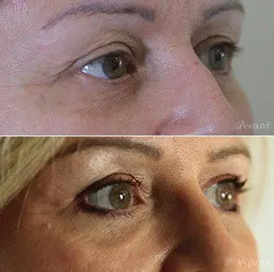 avant-apres- blépharoplastie dr hayot