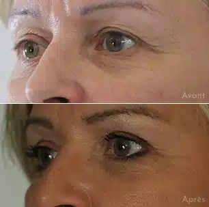 avant apres 3 nano lipostructure dr hayot – Docteur Bernard Hayot