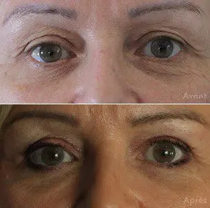 avant-apres-pinch-blepharoplastie