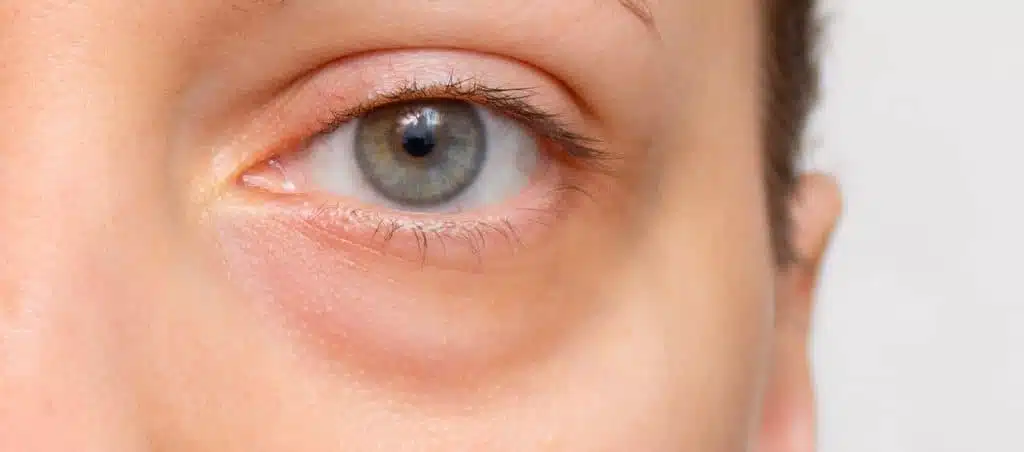 Cernes sous les yeux : chirurgie ou lipofilling, que choisir ? – Docteur Bernard Hayot Cernes poches creux comprendre les differences – Docteur Bernard Hayot