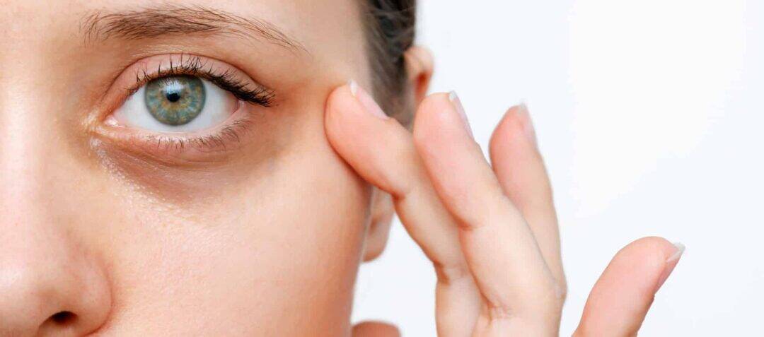 Cernes sous les yeux : chirurgie ou lipofilling, que choisir ?