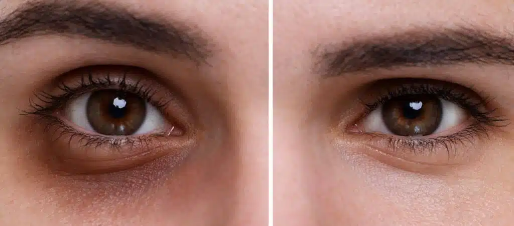 Cernes sous les yeux : chirurgie ou lipofilling, que choisir ? – Docteur Bernard Hayot lipofilling des cernes dr hayot – Docteur Bernard Hayot