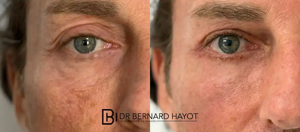 Blépharoplastie à Paris : Guide Complet 2026 pour un Regard Rajeuni Naturellement – Docteur Bernard Hayot chirurgie des paupieres avant apres blepharoplastie superieure – Docteur Bernard Hayot