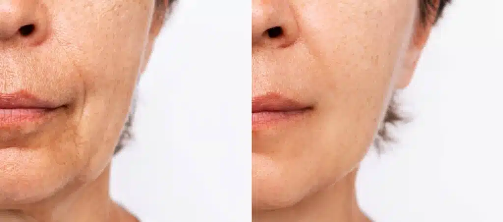 Deep Plane Facelift Paris – Rajeunissement Naturel & Durable – Docteur Bernard Hayot rajeunir visage naturellement – Docteur Bernard Hayot