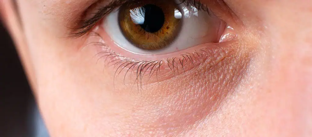 Nano-lipofilling Cernes Pigmentés : La Révolution 2026 de la Médecine Régénérative – Docteur Bernard Hayot nano lipofilling cernes pigmentes avant apres dr hayot paris – Docteur Bernard Hayot