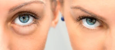 Actualités – Docteur Bernard Hayot Oculoplasticien Paris : Expertise médicale pour la chirurgie du regard