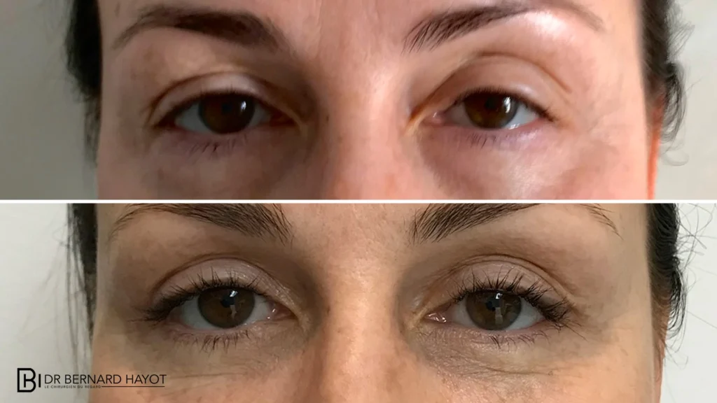Chirurgie Paupières Paris : Techniques Laser & Résultats Naturels – Docteur Bernard Hayot blepharoplastie d addition 4 paupieres ptosis injection graisse – Docteur Bernard Hayot
