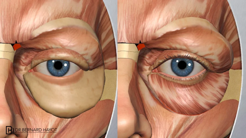Chirurgie Paupières Paris : Techniques Laser & Résultats Naturels – Docteur Bernard Hayot paupieres tombantes correction chirurgicale – Docteur Bernard Hayot