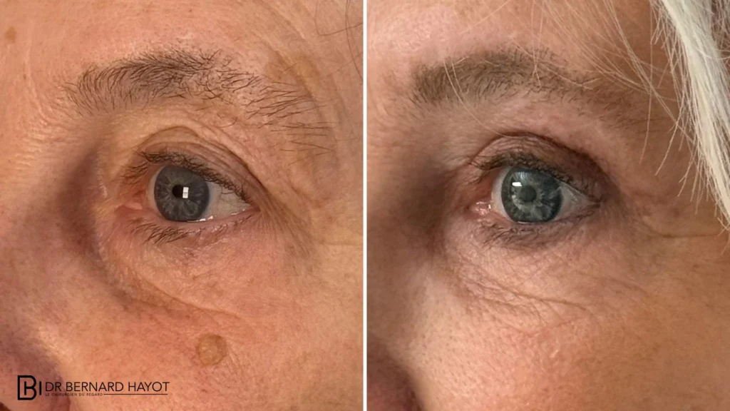 Chirurgie Paupières Paris : Techniques Laser & Résultats Naturels – Docteur Bernard Hayot reprise blepharoplastie inferieure superieure injection graisse – Docteur Bernard Hayot