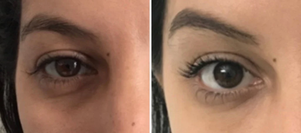 Blépharoplastie hybride laser nanofat : révolution 4D de la chirurgie des paupières – Docteur Bernard Hayot blepharoplastie inferieure avant apres – Docteur Bernard Hayot