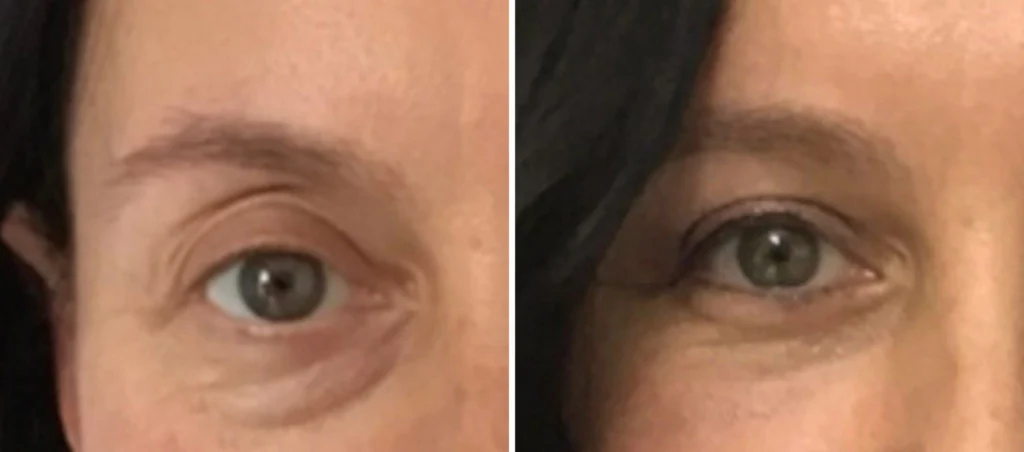 Les 4 questions qu'on me pose avant une blépharoplastie supérieure – Docteur Bernard Hayot blepharoplastie superieure questions – Docteur Bernard Hayot