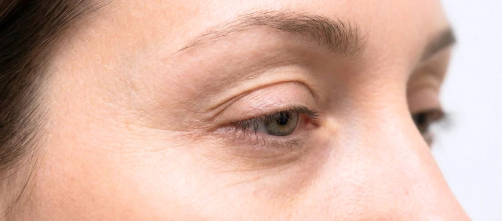 Blépharoplastie Réparatrice Après Injections Ratées à Paris – Docteur Bernard Hayot 3 – Docteur Bernard Hayot