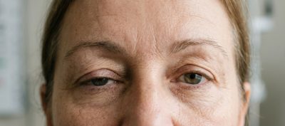 Новости – Docteur Bernard Hayot Птоз века: понять причины и найти подходящее лечение: Полное руководство