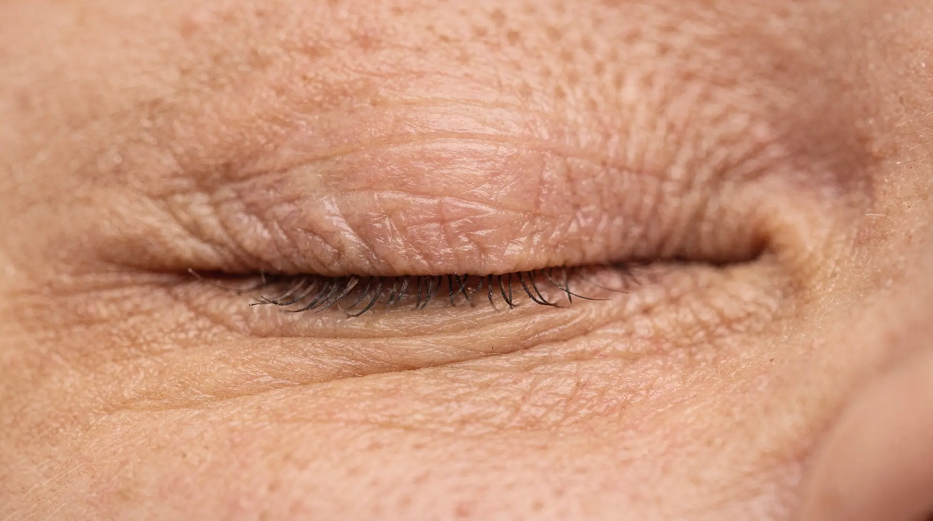 Chirurgie du Ptosis et Mullérectomie à Paris – Docteur Bernard Hayot chirurgie ptosis mullerectomie paris