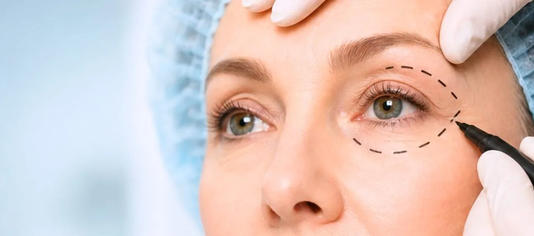 Ambulatory Blepharoplasty in Paris: The Complete Guide for a Rejuvenated Look