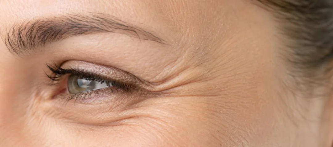 Botox du regard et patte-d&rsquo;oie : ce qu&rsquo;il peut faire