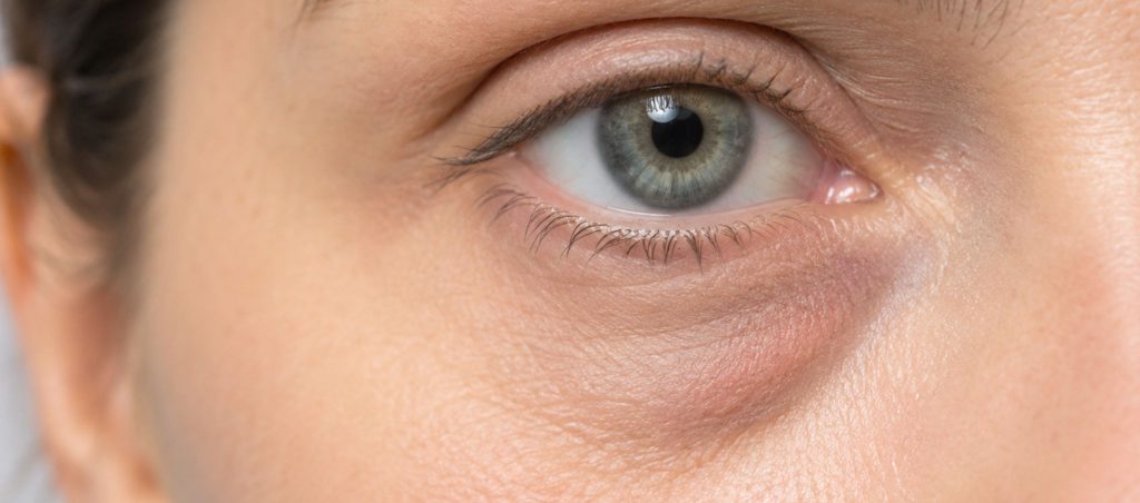 Botox du regard et patte-d'oie : ce qu'il peut faire – Docteur Bernard Hayot 3 – Docteur Bernard Hayot