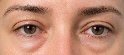 Home – Docteur Bernard Hayot Boule de graisse sous les yeux : identifier la cause