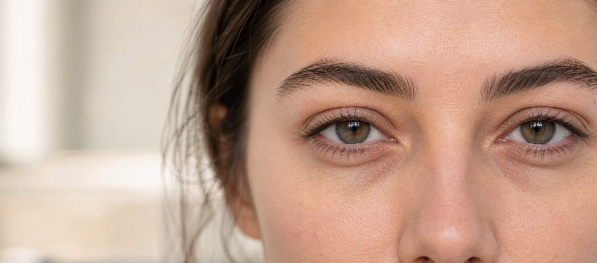 Blépharoplastie inférieure : poches, cernes creux et limites à connaître – Docteur Bernard Hayot Contour inférieur de l’œil avec transition entre paupière, cerne et joue