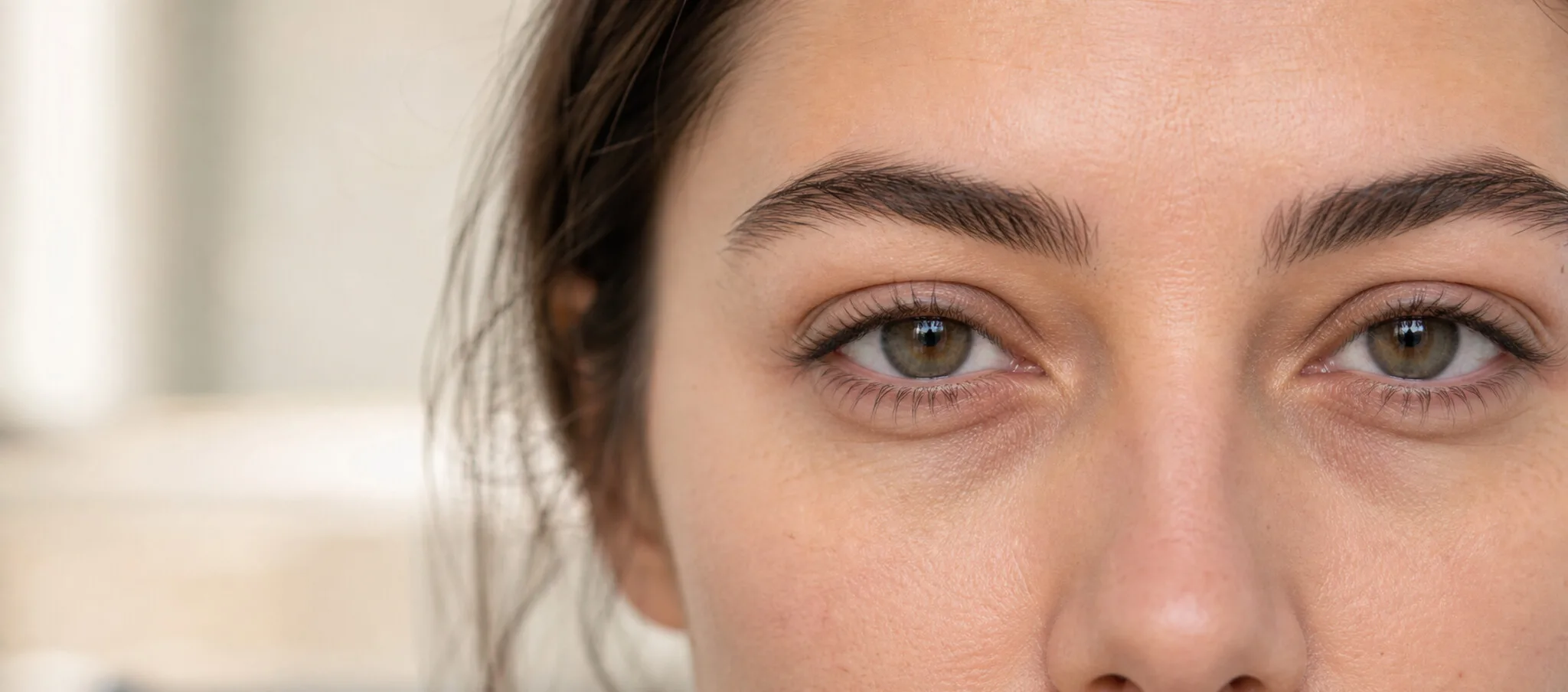 Blépharoplastie inférieure : poches, cernes creux et limites à connaître – Docteur Bernard Hayot Contour inférieur de l’œil avec transition entre paupière, cerne et joue