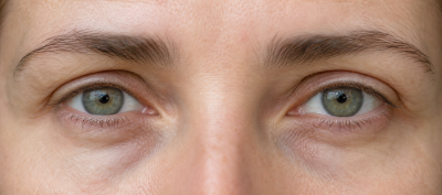 Actualités – Docteur Bernard Hayot Ozempic face et regard : pourquoi les cernes et les paupières se creusent après une perte de poids