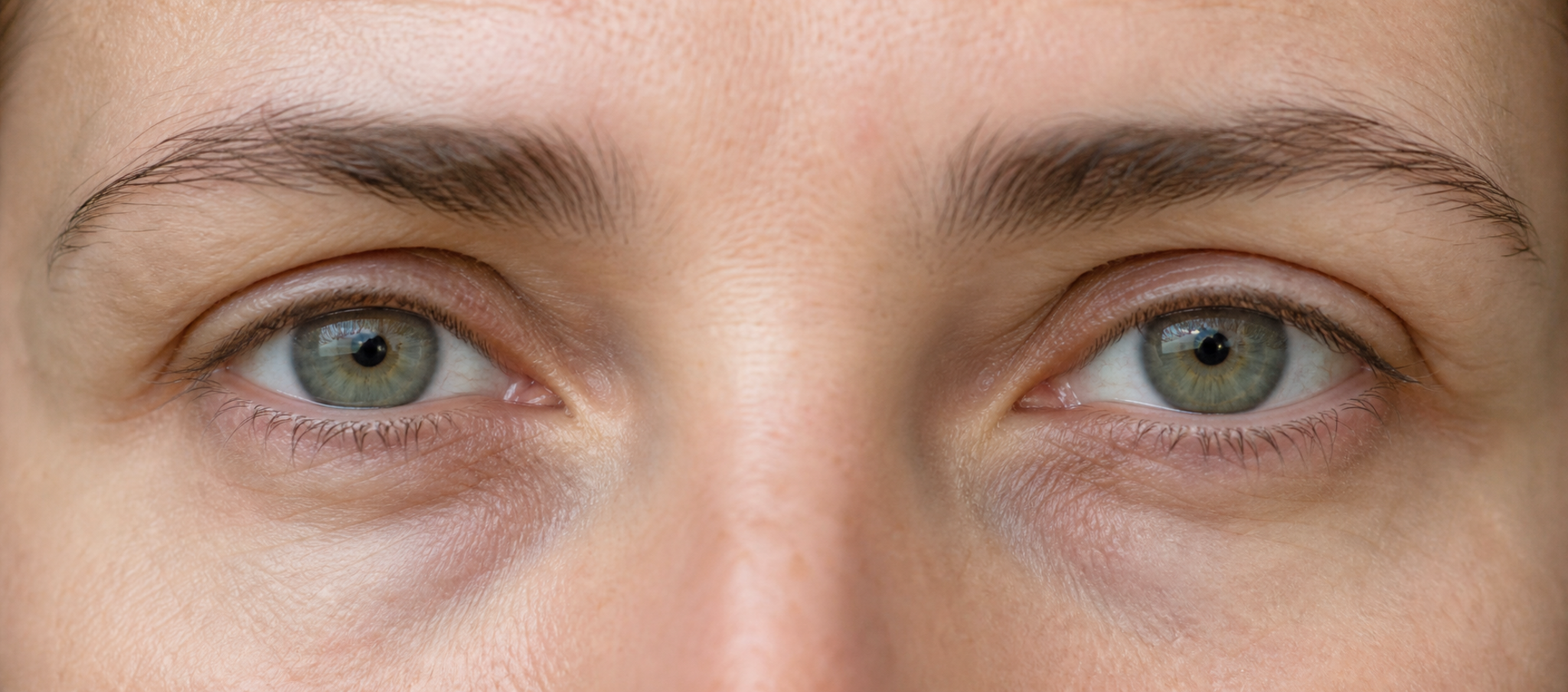 Ozempic face et regard : pourquoi les cernes et les paupières se creusent après une perte de poids – Docteur Bernard Hayot Regard et cernes creux après perte de poids, sans visage complet ni outil médical
