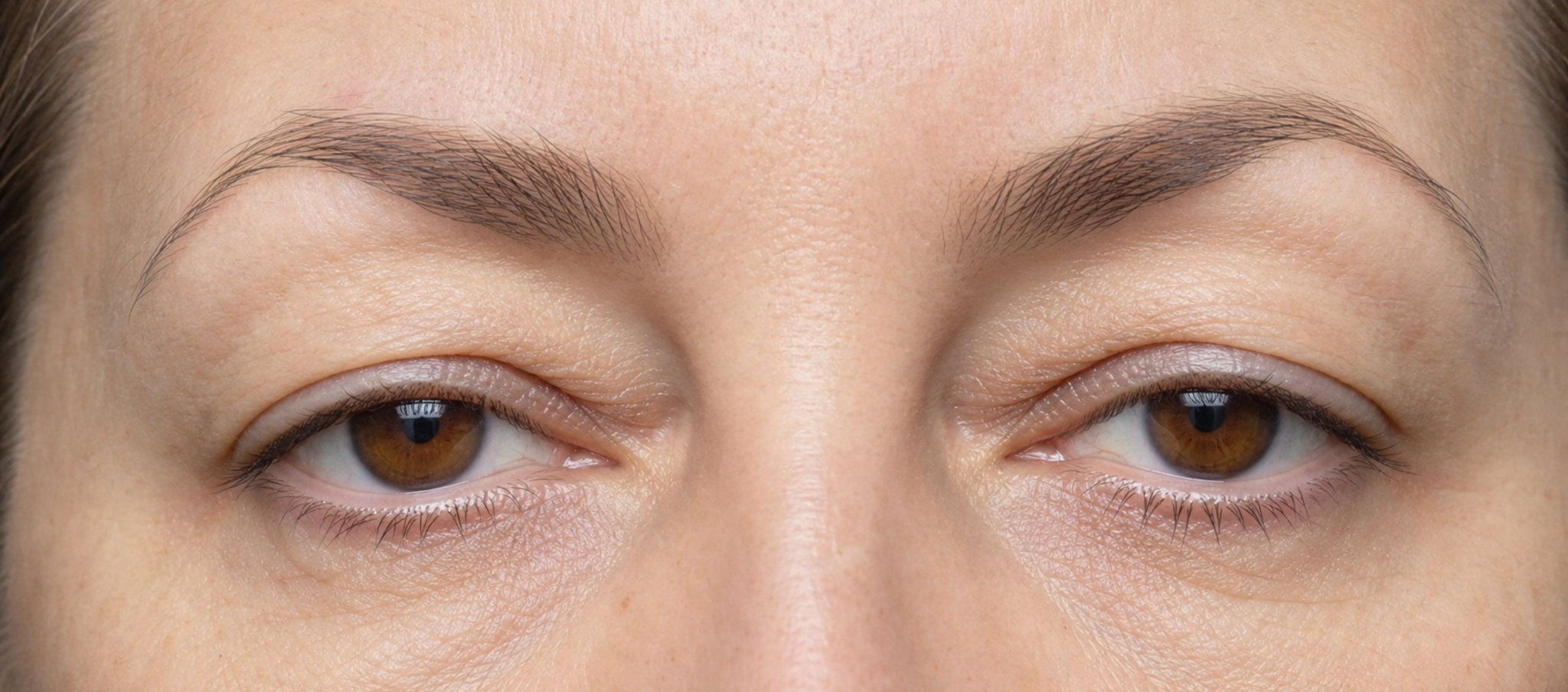 Paupière tombante : ptosis, excès de peau ou sourcil bas ? – Docteur Bernard Hayot Analyse du sourcil et de la paupière supérieure dans un regard fatigué