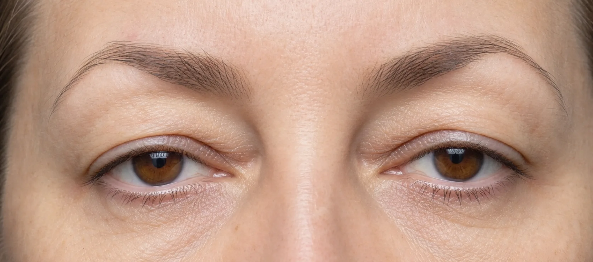 Paupière tombante : ptosis, excès de peau ou sourcil bas ? – Docteur Bernard Hayot Analyse du sourcil et de la paupière supérieure dans un regard fatigué