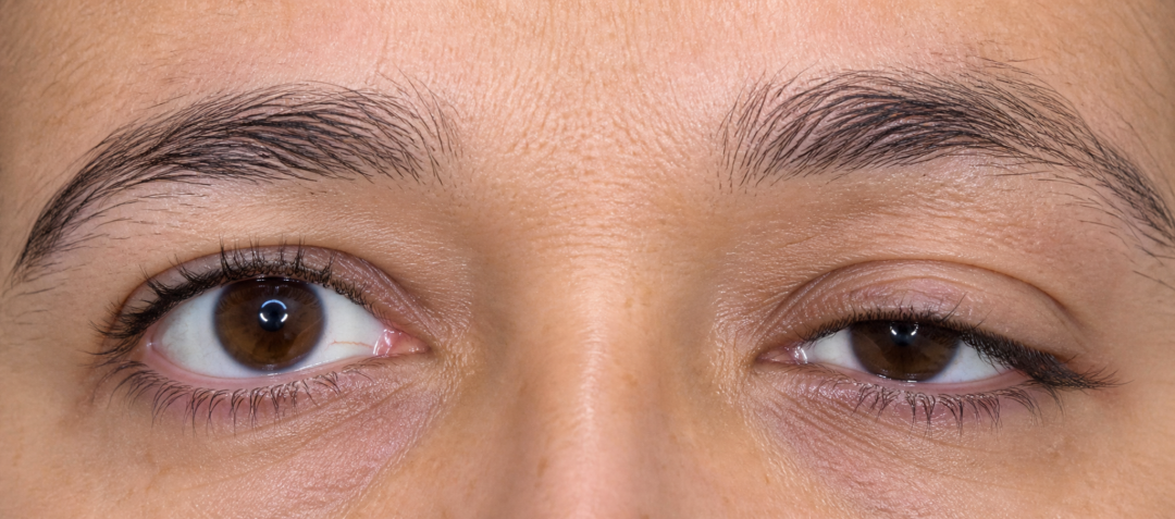 Paupière tombante : ptosis, excès de peau ou sourcil bas ?