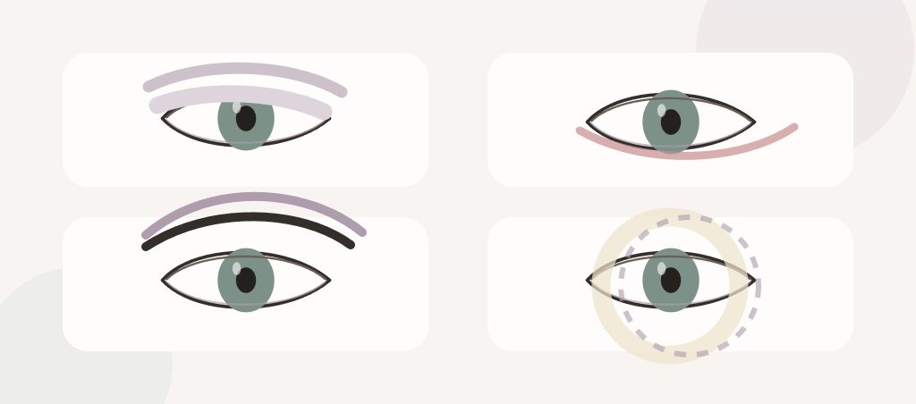 Un œil plus petit ou fermé que l’autre : quelles causes ? – Docteur Bernard Hayot Schéma comparant une asymétrie liée à la peau, au ptosis, au sourcil et à l’orbite