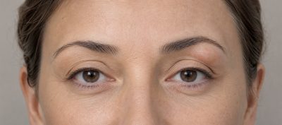 Glande lacrymale gonflée : prolapsus ou autre cause ?
