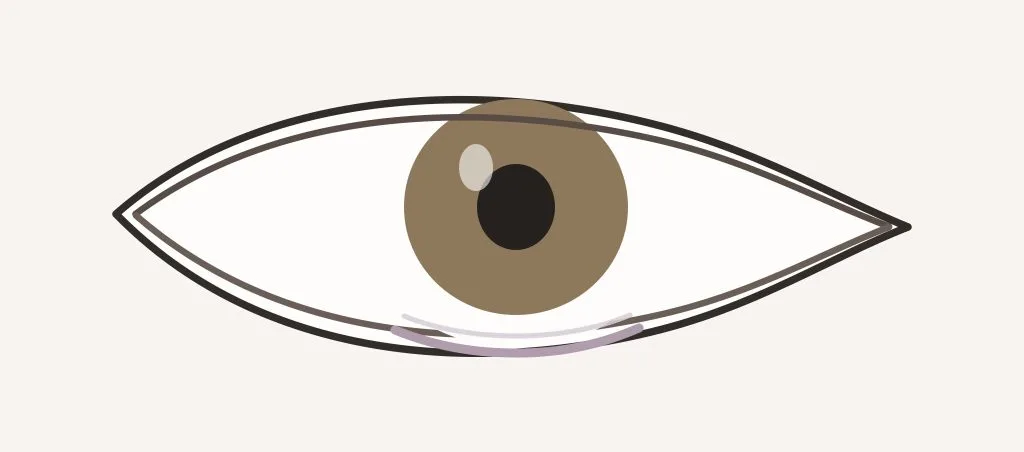 Scleral show après blépharoplastie : rétraction ou ectropion ? – Docteur Bernard Hayot Schéma d’une bande de sclère visible entre la cornée et le bord de la paupière inférieure